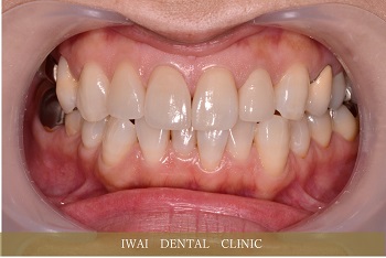 前歯の治療例（3）
